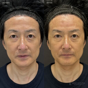 福岡天神で額ヒアルロン酸｜ボリューマで50代男性の額を自然に若返らせる効果と料金相場の症例写真