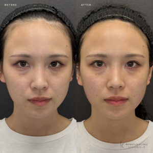 福岡天神のザーフ(XERF)で20代女性のフェイスライン引き締め｜料金・効果まとめの症例写真