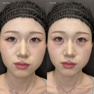 大阪梅田で涙袋ヒアルロン酸｜20代女性がボリフトで自然な涙袋を形成した効果と料金の症例写真