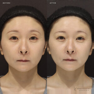 新宿でヒアルロン酸（目の上）上手いクリニック｜ボルベラで40代女性のたるみ改善の症例写真