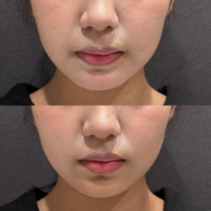 東京田町の顎ヒアルロン酸｜10代女性がボラックスで叶えるEラインの効果と費用の症例写真