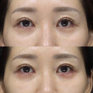 新宿で涙袋ヒアルロン酸が上手いクリニック｜40代女性がボルベラで自然な潤い目元を実現の症例写真