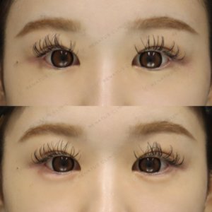 新宿で涙袋ヒアルロン酸｜ボルベラで自然な丸みを叶えた20代女性の効果と料金の症例写真