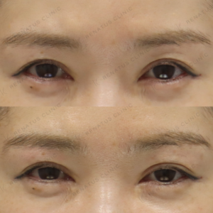 新宿の目の上ヒアルロン酸｜ボルベラで自然なふっくら感を叶えた30代女性の効果と料金の症例写真