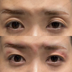 東京田町で目の上ヒアルロン酸の効果と費用｜ボルベラで40代女性の上まぶたくぼみ改善の症例写真