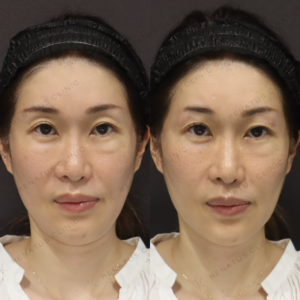 新宿で目の上ヒアルロン酸｜ボルベラで40代女性が実感した効果と料金相場の症例写真