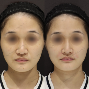 新宿でほうれい線ヒアルロン酸・ボリフトの効果と料金｜30代女性の症例の症例写真