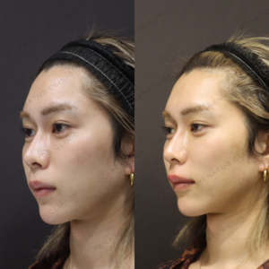 新宿の唇ヒアルロン酸｜ボルベラで自然な厚みを叶えた20代男性の効果と料金の症例写真
