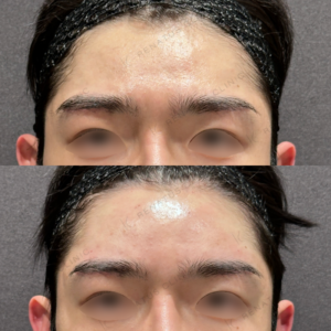 東京田町で額・こめかみヒアルロン酸｜20代男性がボリューマで立体感アップ・効果と費用を解説の症例写真