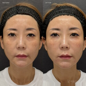 福岡天神のヒアルロン酸でゴルゴライン・口角改善｜40代女性がボリフトで選ぶ名医の症例写真