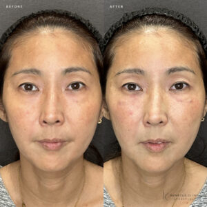大阪梅田のゴルゴラインにヒアルロン酸ボリューマ｜50代女性の効果と料金相場の症例写真