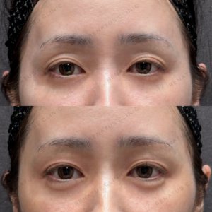 東京田町で涙袋ヒアルロン酸｜ボルベラで自然な涙袋形成・30代女性の効果と料金相場の症例写真