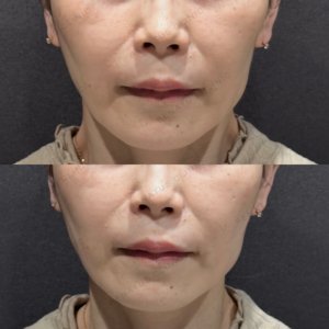 東京田町のヒアルロン酸（頬）｜40代女性がボリフトで実感した効果と費用の症例写真