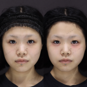 新宿で涙袋ヒアルロン酸ならボルベラ｜10代女性の効果と料金相場の症例写真