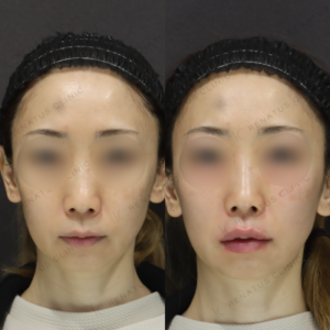 新宿で唇ヒアルロン酸｜40代女性がボルベラで叶えた自然な丸みと潤いの症例写真