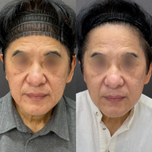 【福岡天神】60代男性の糸リフト｜たるみ改善の効果・料金相場とおすすめポイントの症例写真