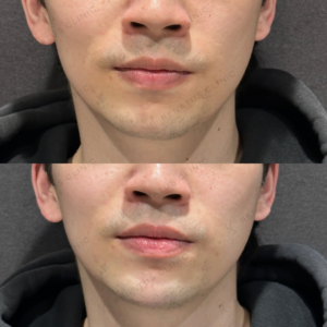 東京田町で顎ヒアルロン酸｜ボラックスで整えた20代男性の効果と料金相場の症例写真