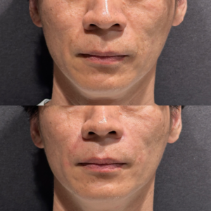 東京田町でほうれい線・鼻翼基部ヒアルロン酸｜40代男性がボリフトで自然な若返りを実現の症例写真