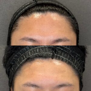 大阪梅田のヒアルロン酸ボライト（VOLITE）で額に潤いとハリを｜30代男性の効果と料金の症例写真