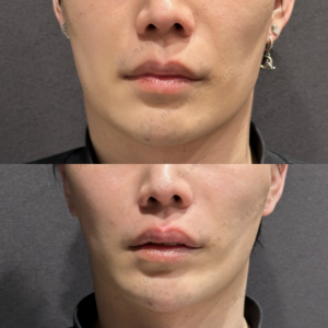 東京田町｜ヒアルロン酸ボルベラで鼻翼基部・唇・顎を整えた20代男性の効果と料金相場の症例写真