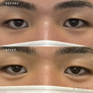 福岡天神で涙袋ヒアルロン酸｜ボルベラで自然な涙袋を作る20代男性の効果と料金の症例写真