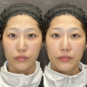 大阪梅田の鼻翼基部ヒアルロン酸｜ボリューマで小鼻を整えた20代女性の効果と料金の症例写真