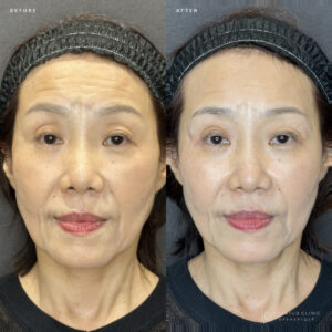 大阪梅田のヒアルロン酸目の上｜ボルベラで60代女性のたるみを自然に改善する効果と料金の症例写真