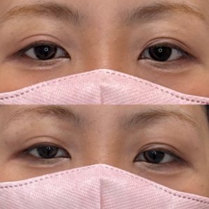 福岡天神のヒアルロン酸注射｜ボルベラで目の上を自然に若返り30代女性の効果と料金の症例写真