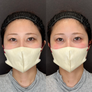 大阪梅田で涙袋ヒアルロン酸｜ボルベラの効果・料金相場を30代女性が解説の症例写真
